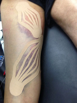 Kinesio Taping